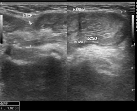 Abdomen Sonography Strangulated Inguinal Hernia Clinical Report My