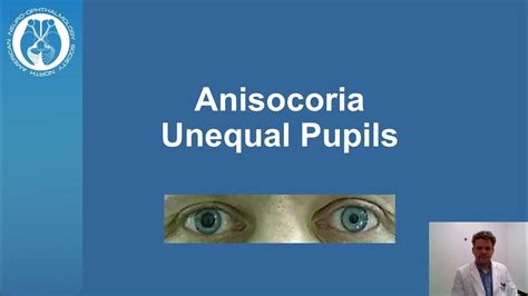 Anisocoria Unequal Pupil Size Youtube