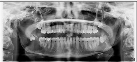 Figure 1 From Bilateral Mandibular Dentigerous Cysts In A Non Syndromic