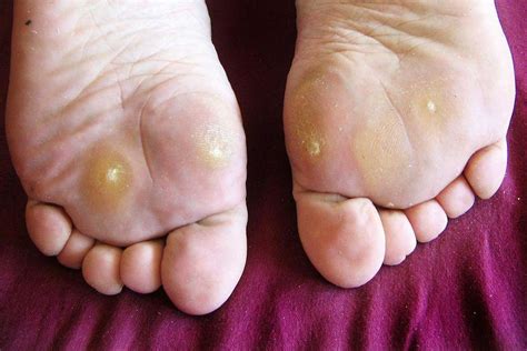 Is It A Plantar Wart Or A Callous Or A Corn Dr Wenjay Sung Podiatrist