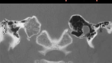 How To Read Temporal Bone Ct Scan Youtube