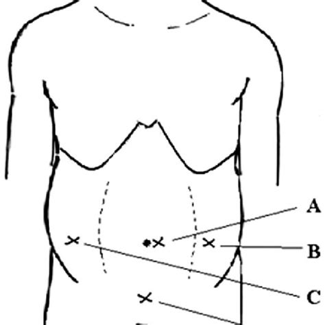 Distribution Of Trocar Sites Of Laparoscopy For Abdominal Stab Wounds
