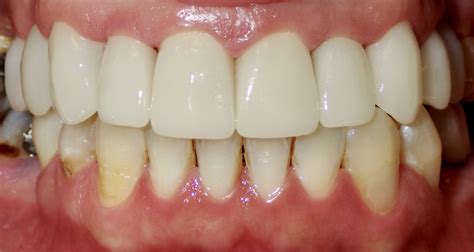 Dental Case Study 37 North Shore Restorative And Implant Dentistry