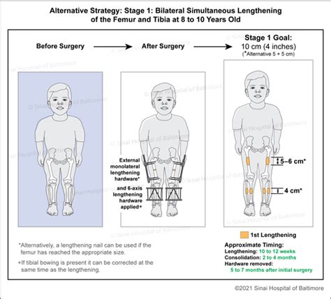 Dwarfism International Center For Limb Lengthening