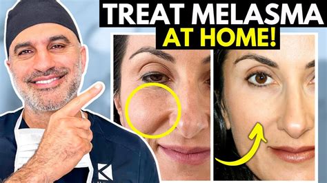 What You Need To Know About Treating Melasma At Home The Right Way
