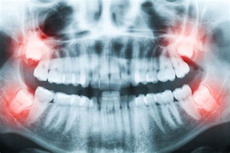 Can Wisdom Teeth Cause Tmj Tmj Symptoms And Causes
