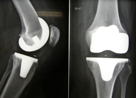 Elle présente les prothèses totales de genoux et la technique chirurgicale (par le docteur marc clemens avec la collaboration du dr g. Chirurgie Orthopédique :: Clinique Sarrus Teinturier ...