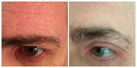 2 years on Dupixent before and after : r/eczema