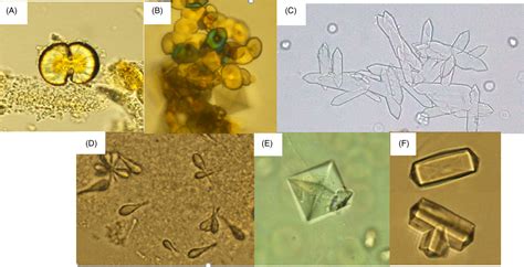 Differential Identification Of Urine Crystals With Morphologic