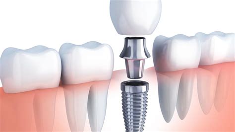 Por Qu Se Usa Titanio En Los Implantes Dentales Uni Est Tica Dental