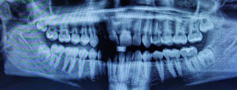 Southern Georgia Oral Surgery Tmj And Upper Wisdom Tooth Position