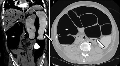 A Ct Scan Of The Abdomen Showed Massive Dilatation Of The Colon Star