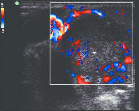 Color Doppler Ultrasound Image Of Malignant Lymph Node Showing Download Scientific Diagram