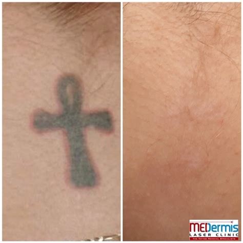 Before And After Tattoo Removal After 3 Sessions