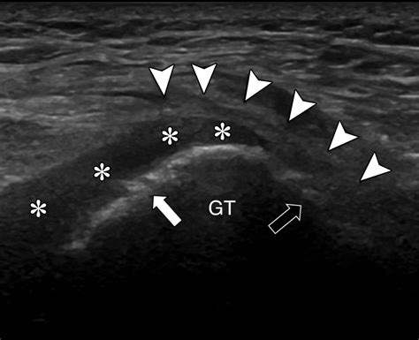 Us Guided Musculoskeletal Interventions In The Hip With Mri And Us