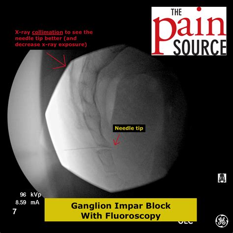 Ganglion Impar Block With Fluoroscopy The Pain Source Makes