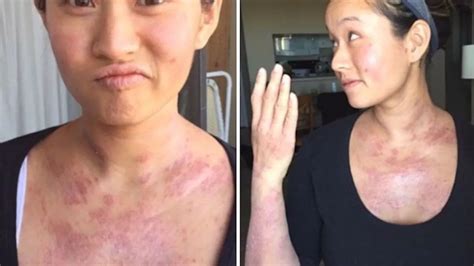 Woman Reveals How Boob Job Left Her With Eczema So Severe She Was