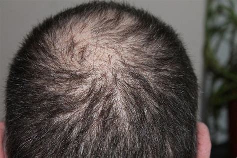 Heres How And Why Men Go Bald Oasdom