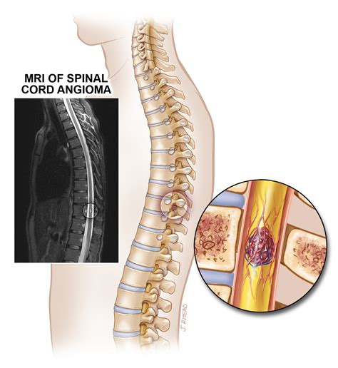 Spinal Cord Lesions Alliance To Cure Cavernous Malformation