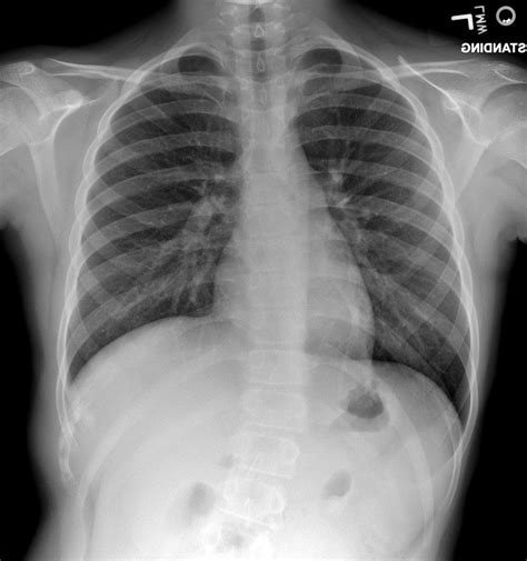 Ewing Sarcome Mixed Lyticsclerotic Lesion Involving The Right