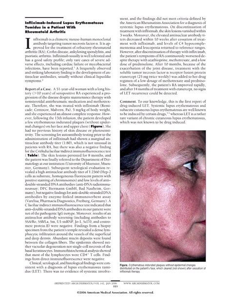 Infliximab Induced Lupus Erythematosus Tumidus In A Patient With Rheumatoid Arthritis