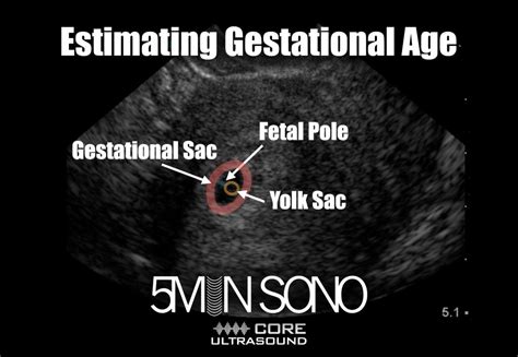 5 Minute Sono Estimating Gestational Age Core Ultrasound