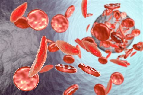 Sickle Cell Anaemia Photograph By Kateryna Kon Science Photo Library Pixels Merch
