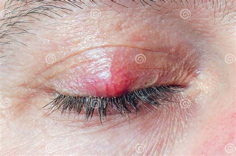 Chalazion On The Eyelid Of A Man Close Up Stock Image Image Of Gland