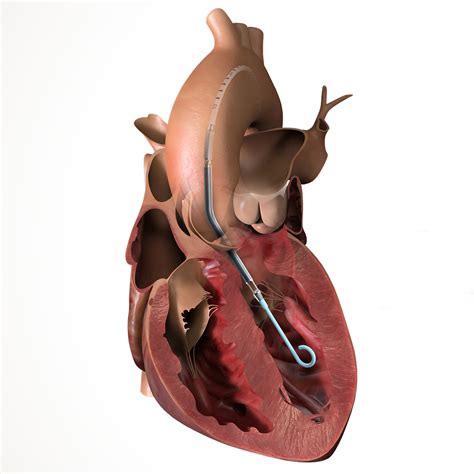 Mobile Learning Lab To Showcase Tiny Impella Heart Pump Monument Health