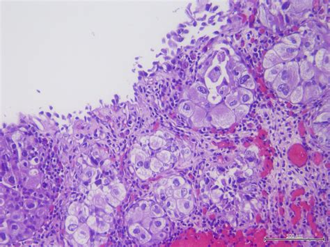 Pathology Outlines Carcinoma In Situ