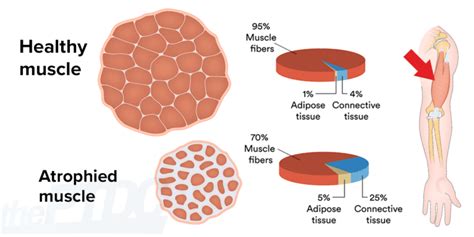 How To Fight Muscle Atrophy After Injury A Personal Trainers Guide