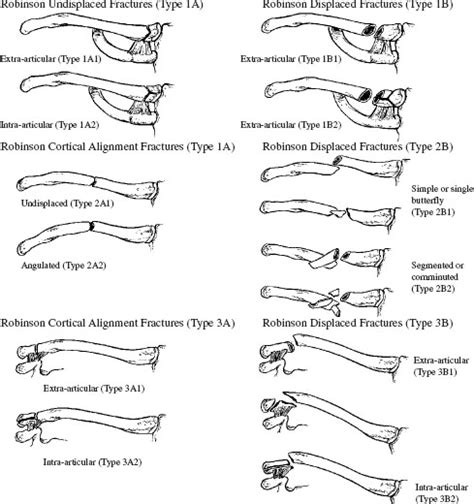 Clavicle Fractures Musculoskeletal Key