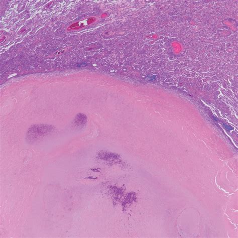 Eosinophilic Granulomatosis With Polyangiitis With A Pathologically