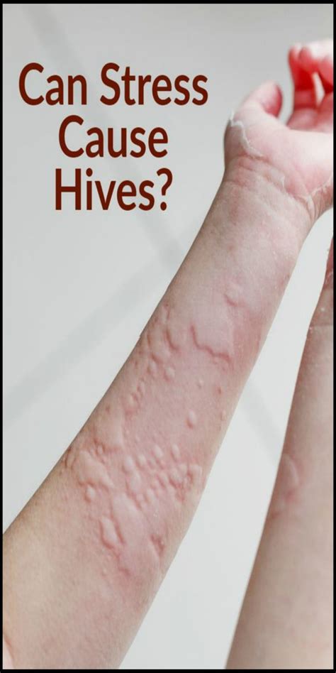 Can Stress Cause Hives The Answer Is Complicated Stress Causes