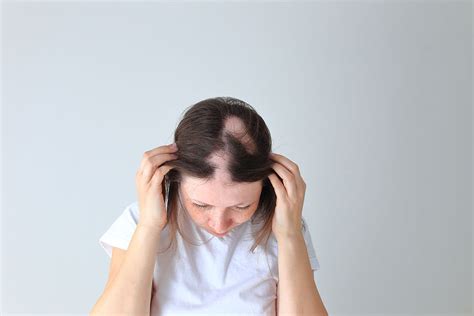 Blog El Mejor Tratamiento Para Alopecia En Mujeres