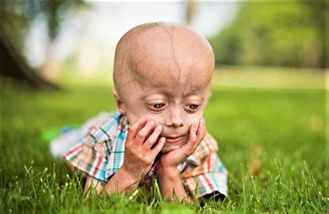 Premature Aging Syndrome Progeria