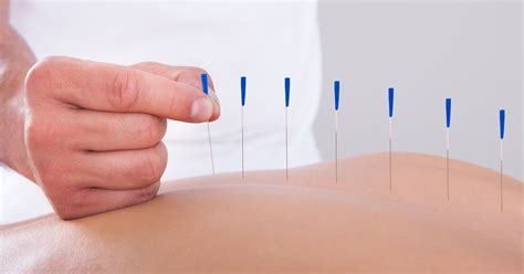 Acupuncture For Fibromyalgia How This Treatment Can Help Fibro