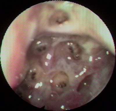 Nasal cavities act as a both a filter and a humidifier, filtering out much of the contaminants in the air that you breathe, and humidifying the air prior to the human have a dorsal body cavity made up of the cranial and spinal cavities. Nasal Myiasis In Humans | www.imgarcade.com - Online Image ...