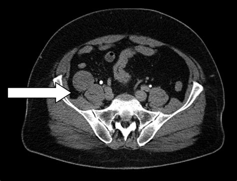 Benign Retroperitoneal Schwannoma A Rare Case Report New Medicine 3