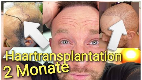 Zweite Haartransplantation T Rkei Monate Bartgrafts Wachsen Youtube