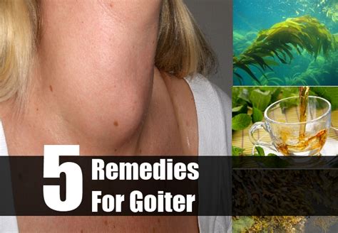 5 Goiter Herbal Remedies Natural Treatments And Cures Search Herbal