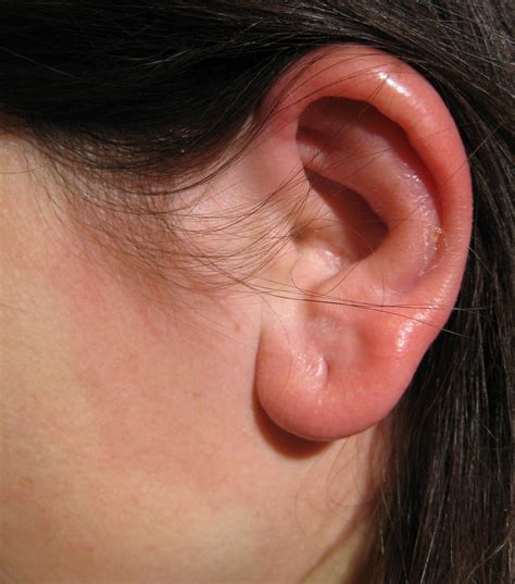 Fileerysipelas Ear