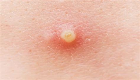 Infected Pimple What It Looks Like Causes And Treatment