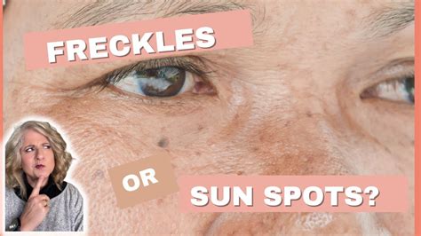 What Is The Difference Between Freckles And Sun Spots Age Spots How Do I Know Which Ones Are
