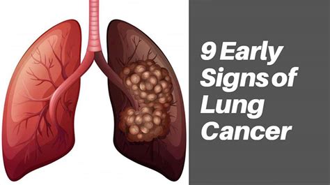9 Early Signs Of Lung Cancer Boxymcom