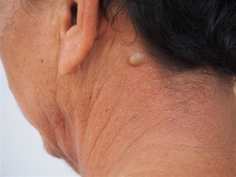 Pictures Of Skin Tags Cysts Lumps And Bumps And When Vrogue Co