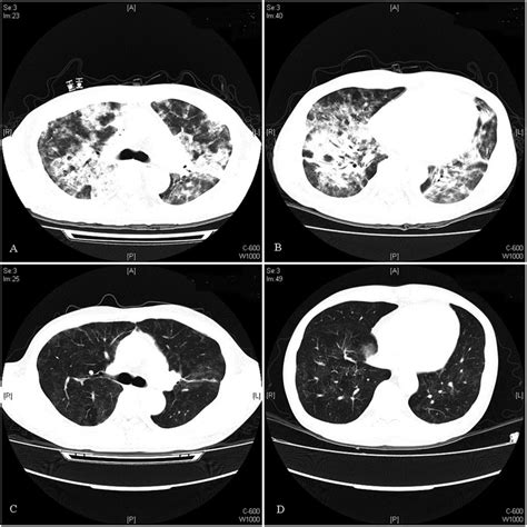 Chest Ct Of Patient No 5 A And B Chest Ct Scans Showing The