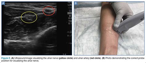 Ulnar Nerve Ultrasound