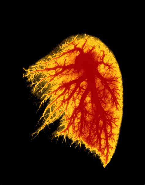 Coloured Angiogram Of Pulmonary Arteries Of Lung Photograph By Fine
