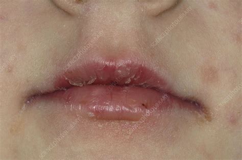 Cracked peeling lips after viral infectio - Stock Image - C004/2409